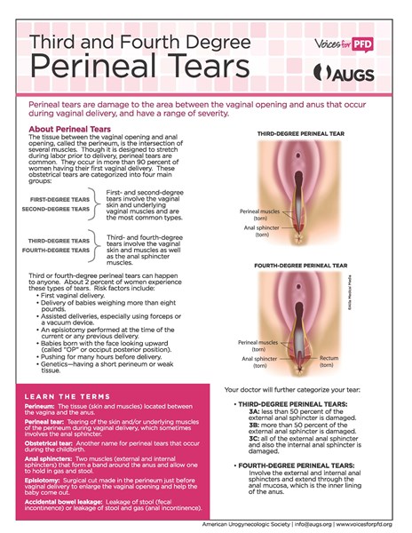 Perineal_Tears